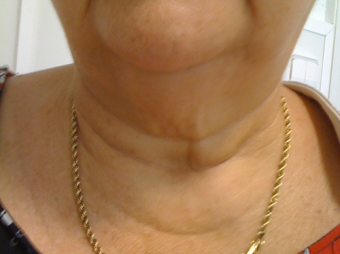 AESTHETIC RESULT OF A THYROID OPERATION