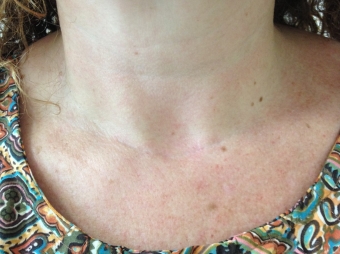 THYROIDECTOMY WITHOUT VISIBLE SCARS