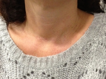 AESTHETIC RESULT OF A THYROID OPERATION