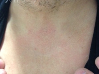 THYROIDECTOMY WITHOUT VISIBLE SCARS